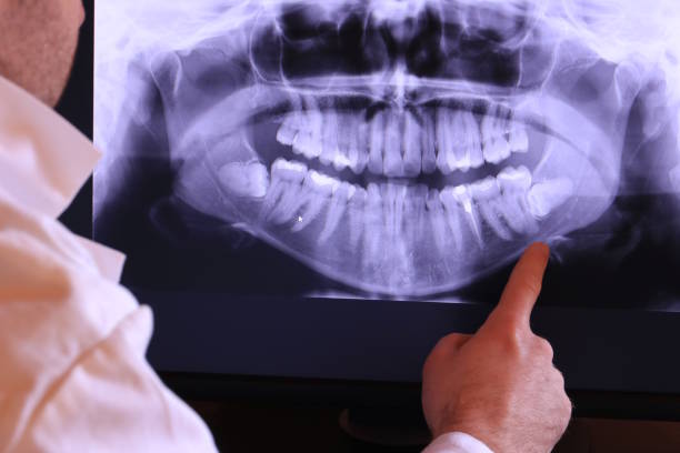 Best Emergency Wisdom Teeth Removal in Ava, MO
